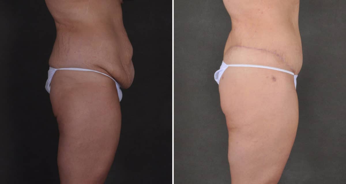 Tummy Tuck Before and After Photos in Omaha, NE, Case 15914