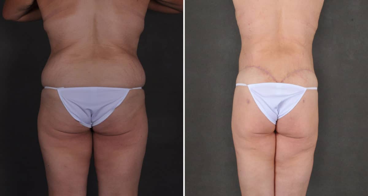 Tummy Tuck Before and After Photos in Omaha, NE, Case 15914