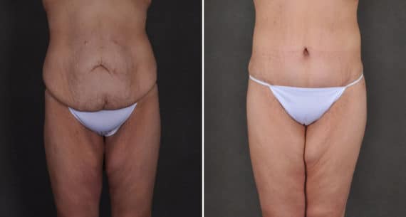 Tummy Tuck Before and After Photos in Omaha, NE, Case 15914