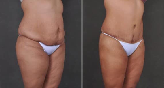 Liposuction Before and After Photos in Omaha, NE, Case 15905