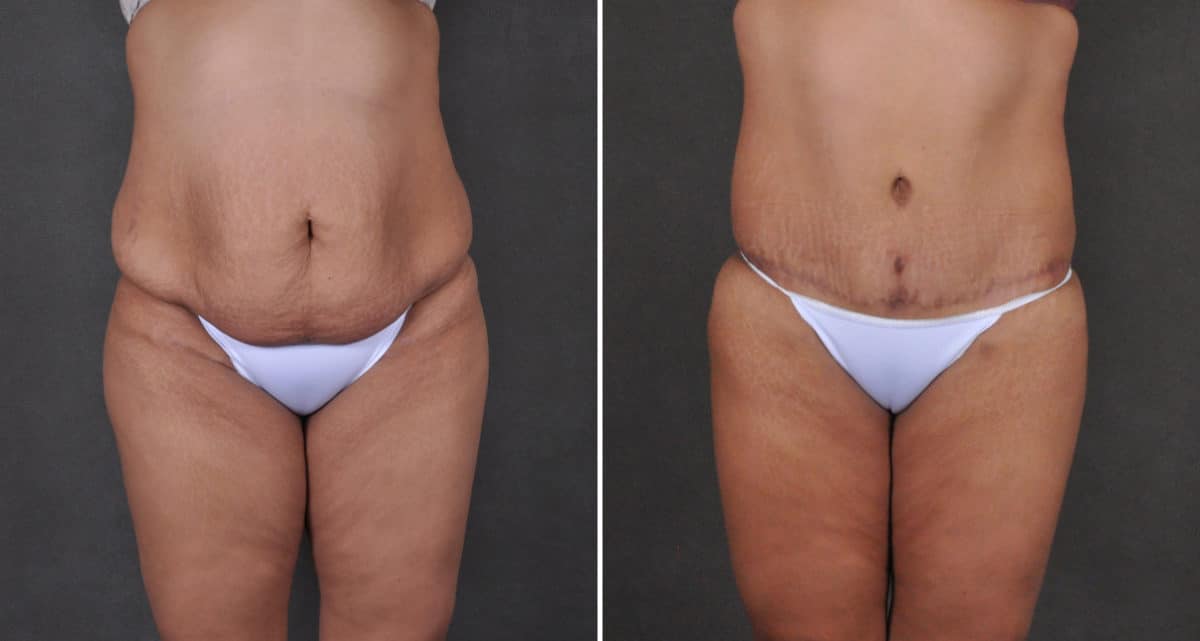 Liposuction Before and After Photos in Omaha, NE, Case 15905