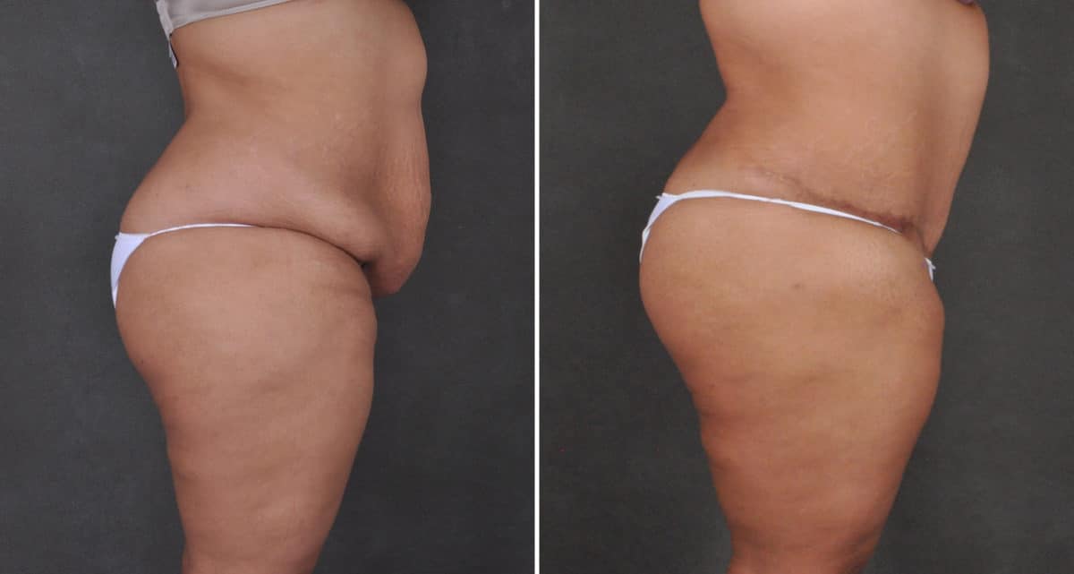 Liposuction Before and After Photos in Omaha, NE, Case 15905