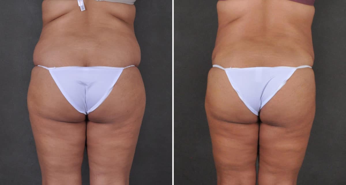 Liposuction Before and After Photos in Omaha, NE, Case 15905