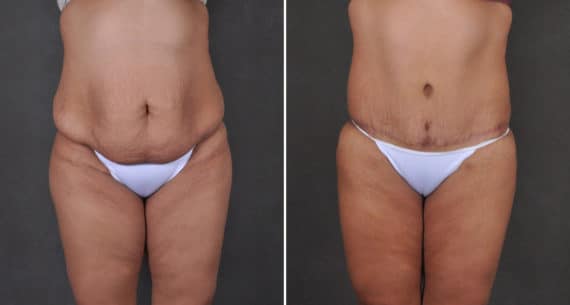 Liposuction Before and After Photos in Omaha, NE, Case 15905