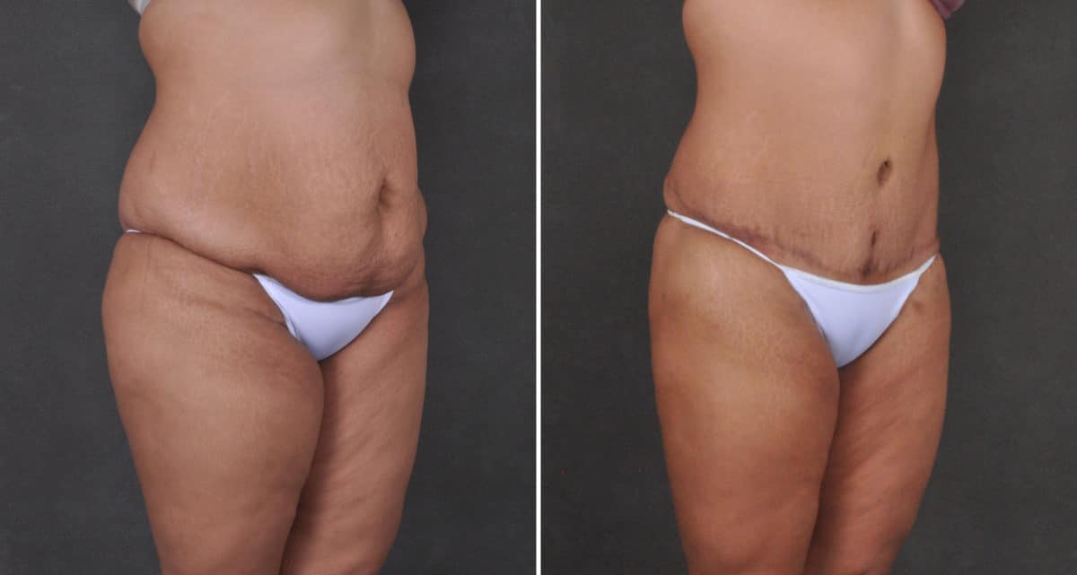 Tummy Tuck Before and After Photos in Omaha, NE, Case 15915