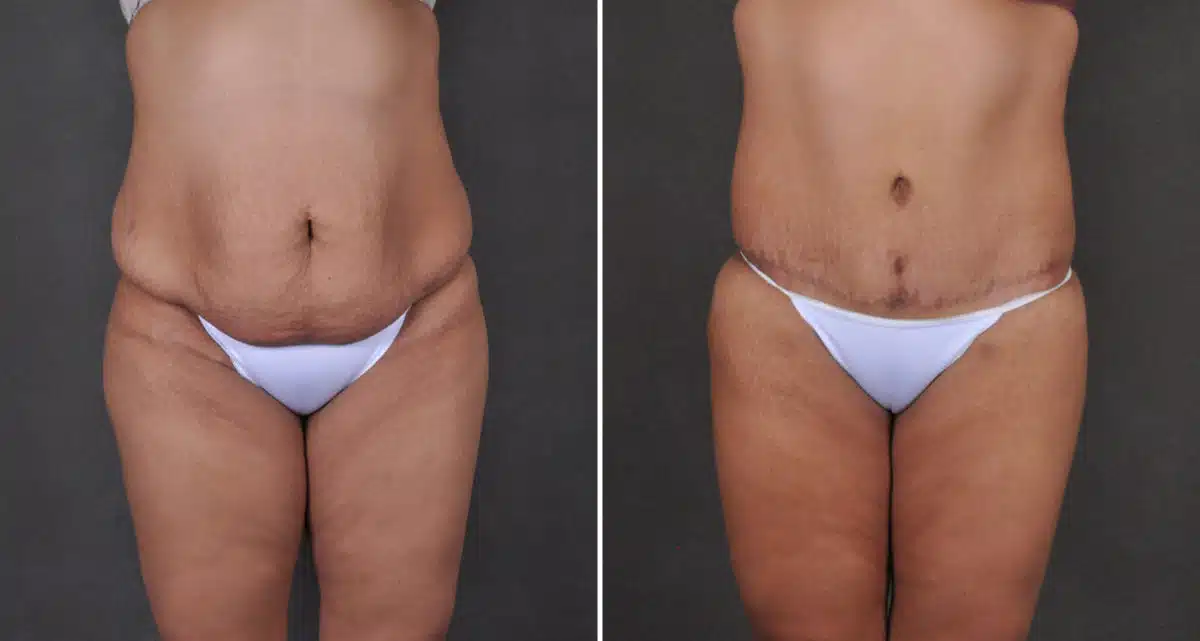 Tummy Tuck Before and After Photos in Omaha, NE, Case 15915