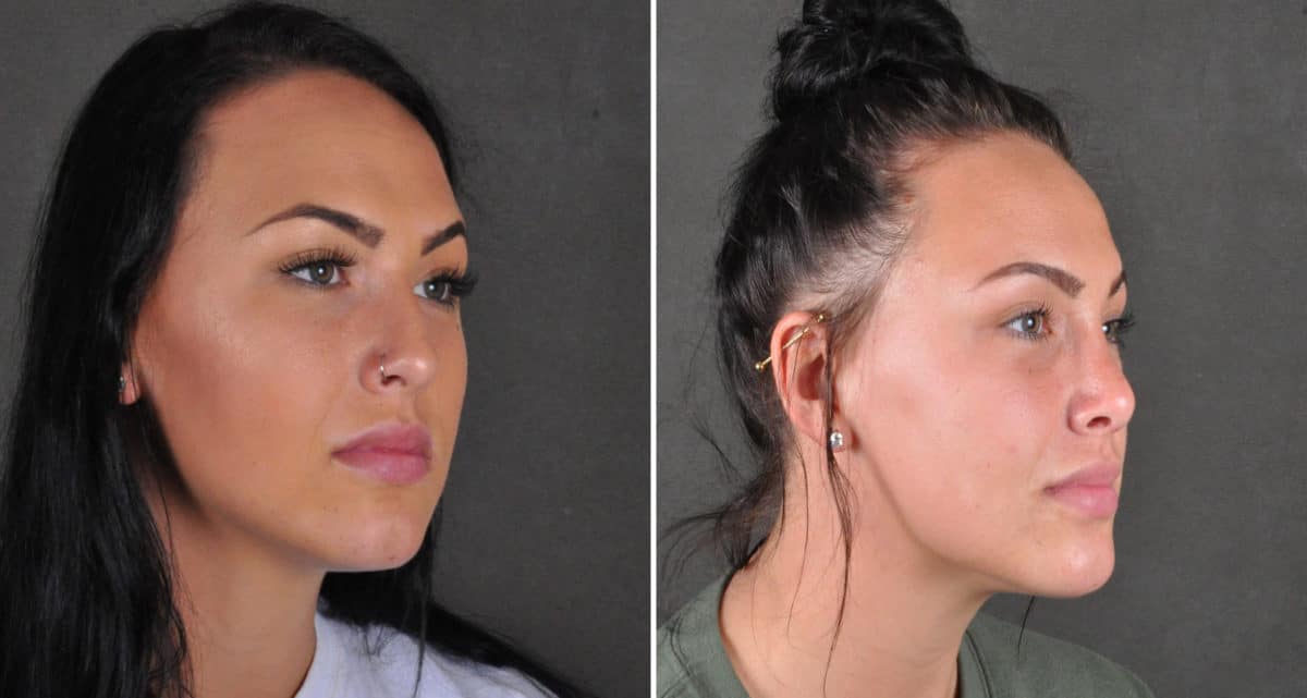 Rhinoplasty Before and After Photos in Omaha, NE, Case 15946