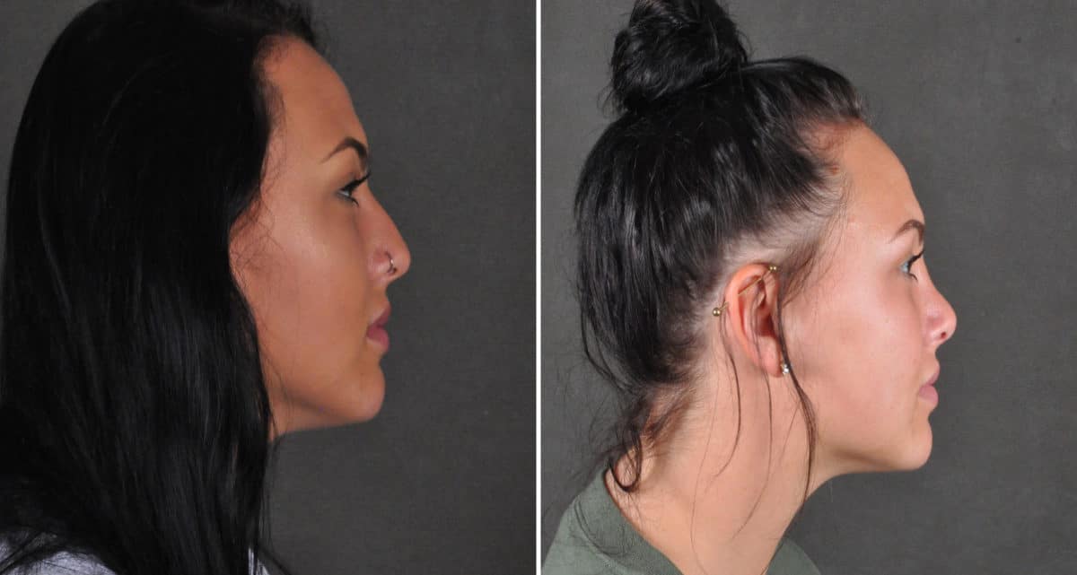 Rhinoplasty Before and After Photos in Omaha, NE, Case 15946