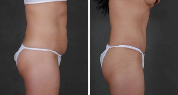 Tummy Tuck Before and After Photos in Omaha, NE, Case 16065