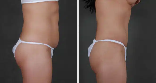 Case 16065, Tummy Tuck Before and After Photos Tummy Tuck Before and After Photos in Omaha, NE, Case 16065