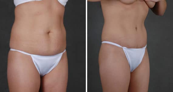 Tummy Tuck Before and After Photos in Omaha, NE, Case 16065