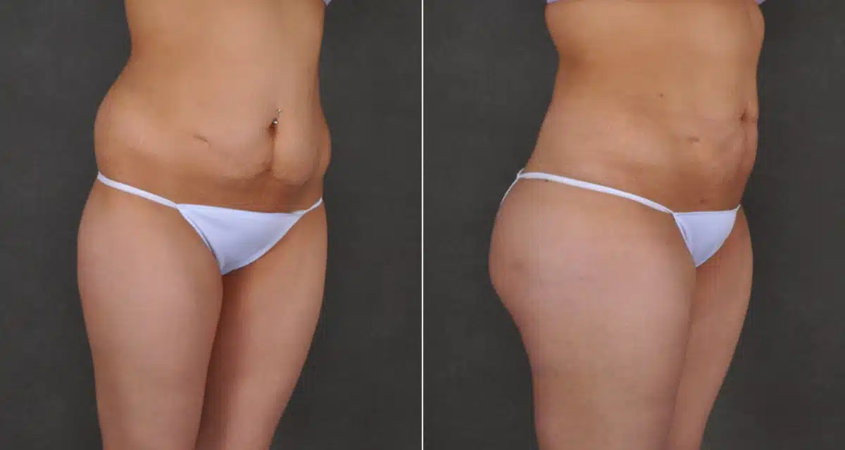 Brazilian Butt Lift Before and After Photos in Omaha, NE, Case 16228