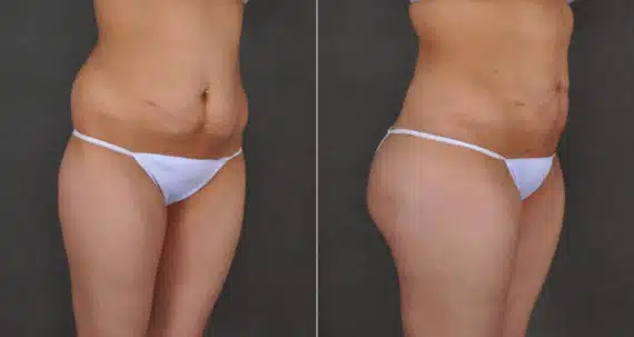 Brazilian Butt Lift Before and After Photos in Omaha, NE, Case 16228