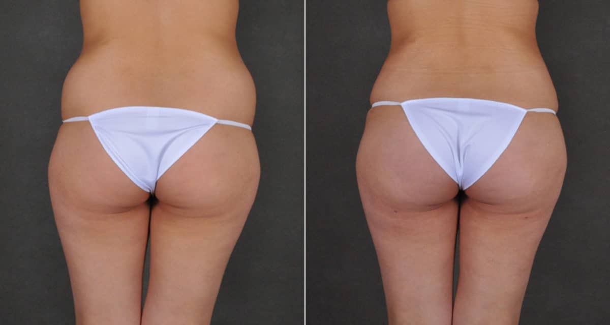 Brazilian Butt Lift Before and After Photos in Omaha, NE, Case 16228