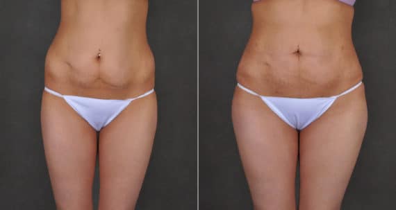 Brazilian Butt Lift Before and After Photos in Omaha, NE, Case 16228