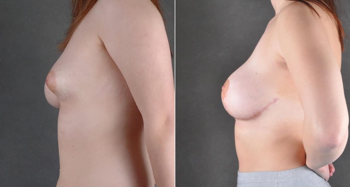 Breast Augmentation Before and After Photos in Omaha, NE, Case 16146