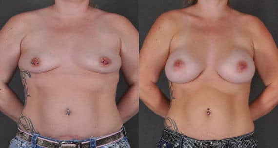 Breast Augmentation Before and After Photos in Omaha, NE, Case 16156