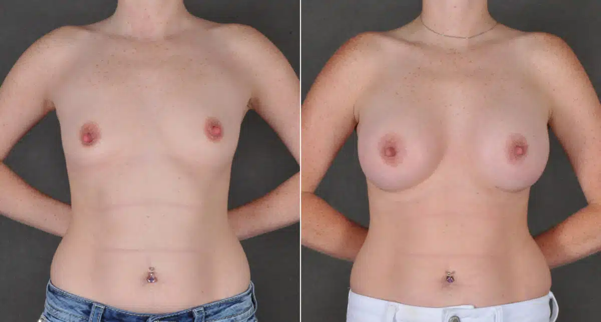 Breast Augmentation Before and After Photos in Omaha, NE, Case 16122