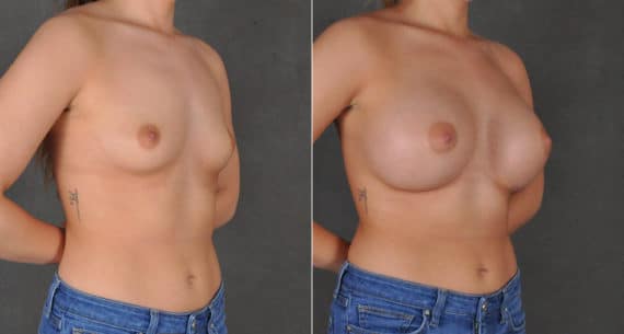 Breast Augmentation Before and After Photos in Omaha, NE, Case 16166