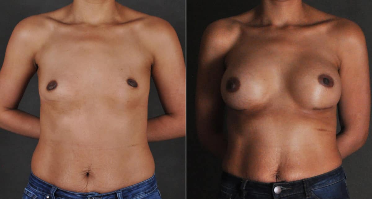 Breast Augmentation Before and After Photos in Omaha, NE, Case 16176