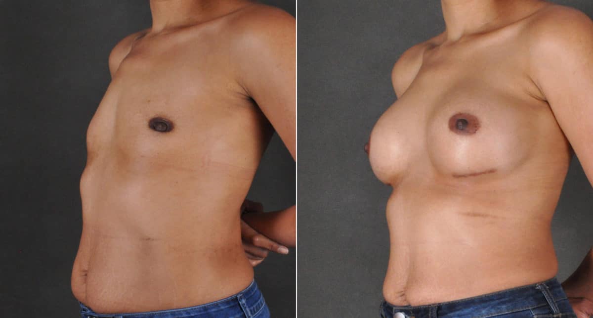 Breast Augmentation Before and After Photos in Omaha, NE, Case 16176