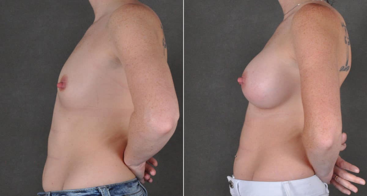 Breast Augmentation Before and After Photos in Omaha, NE, Case 16122