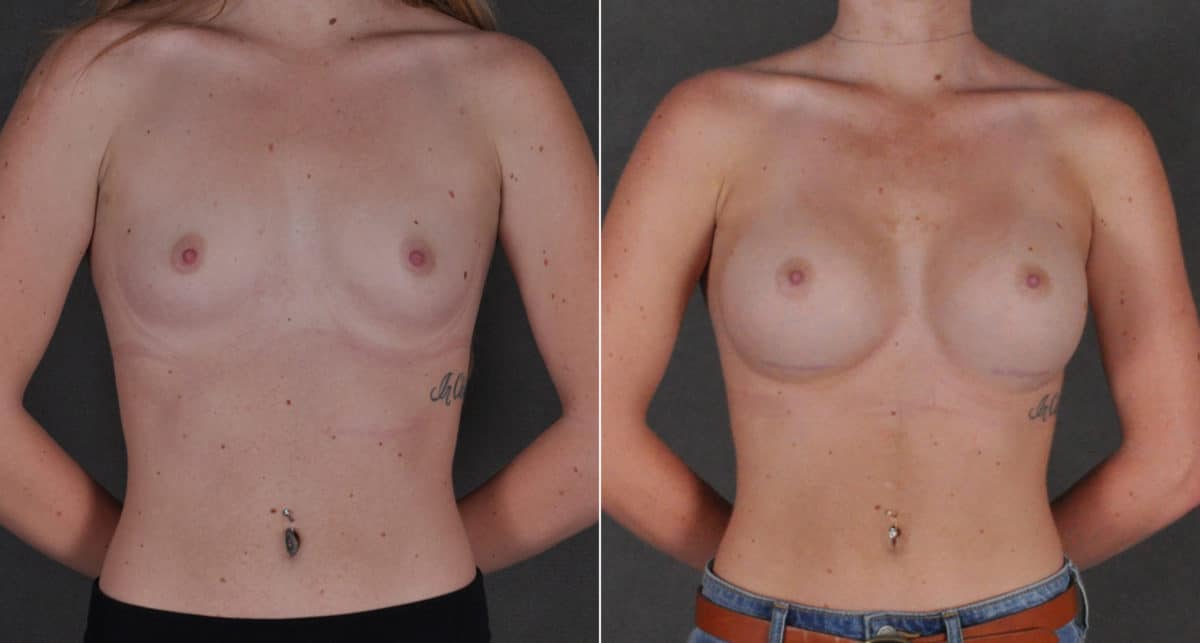 Breast Augmentation Before and After Photos in Omaha, NE, Case 16186