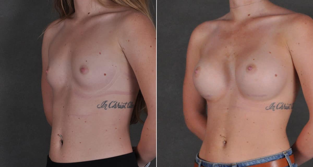 Breast Augmentation Before and After Photos in Omaha, NE, Case 16186