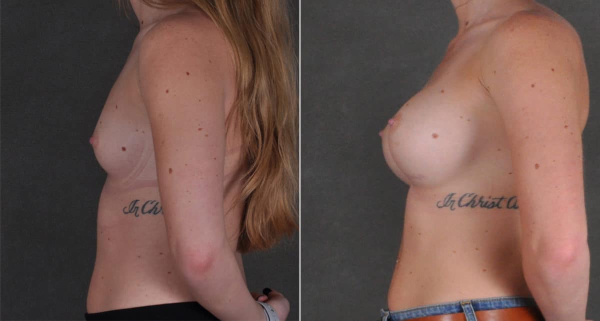 Breast Augmentation Before and After Photos in Omaha, NE, Case 16186