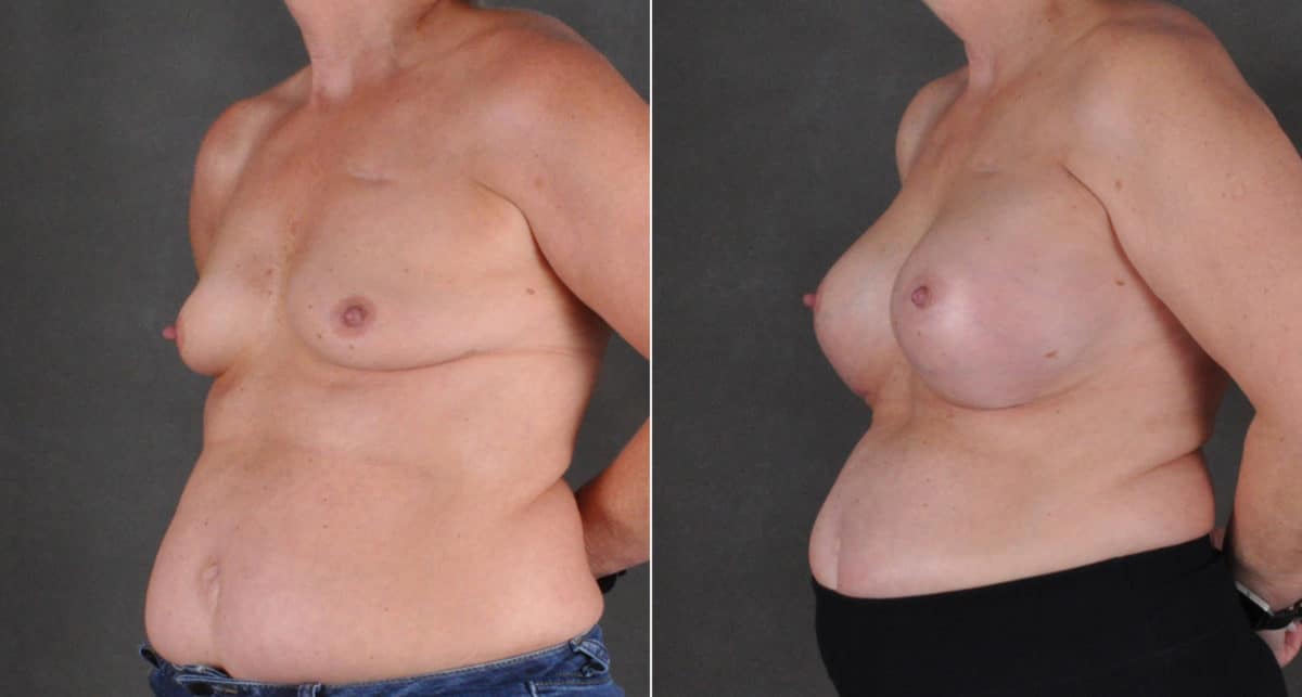 Breast Augmentation Before and After Photos in Omaha, NE, Case 16196