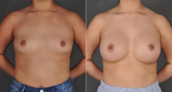 Breast Augmentation Before and After Photos in Omaha, NE, Case 16206