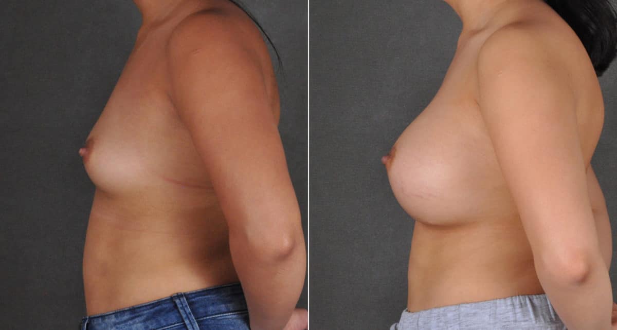 Breast Augmentation Before and After Photos in Omaha, NE, Case 16206