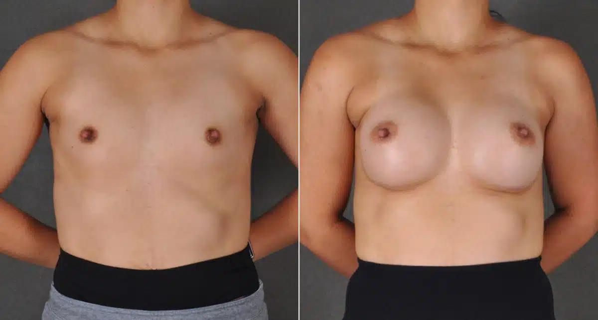 Breast Augmentation Before and After Photos in Omaha, NE, Case 16126