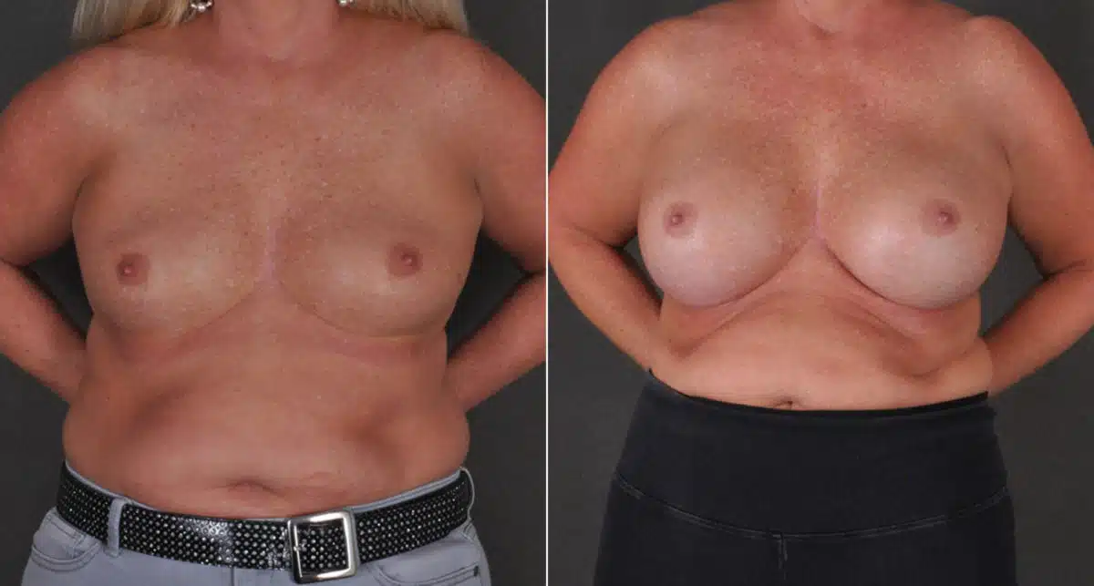 Breast Augmentation Before and After Photos in Omaha, NE, Case 16216