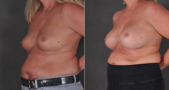 Breast Augmentation Before and After Photos in Omaha, NE, Case 16216