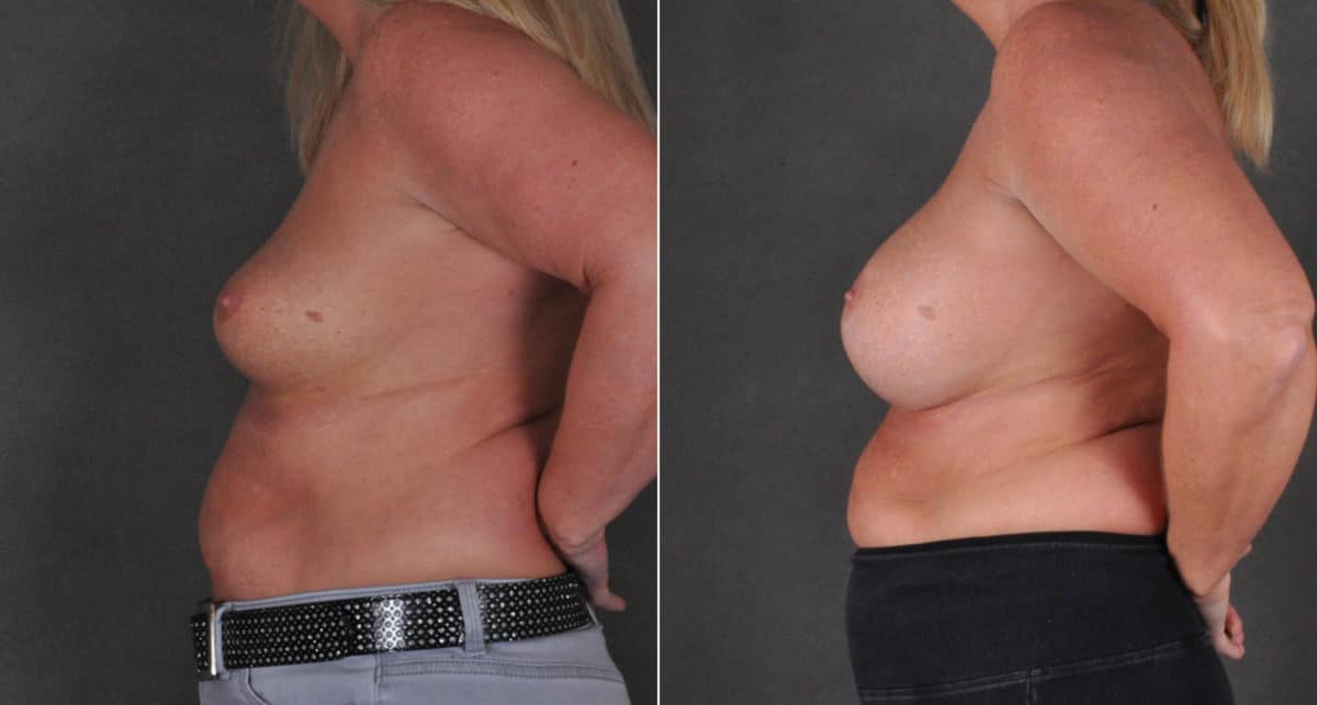 Breast Augmentation Before and After Photos in Omaha, NE, Case 16216