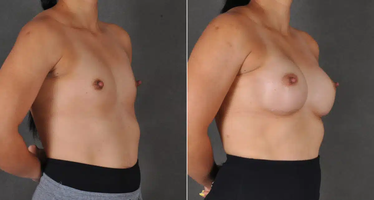 Breast Augmentation Before and After Photos in Omaha, NE, Case 16126