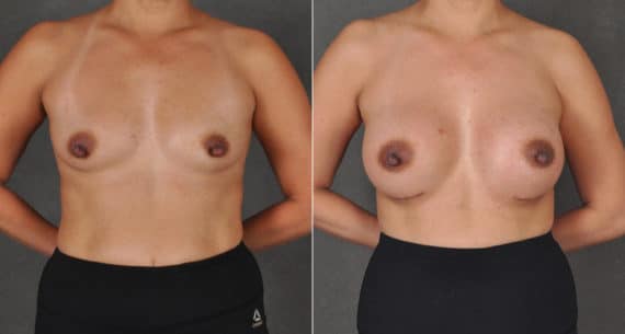 Breast Augmentation Before and After Photos in Omaha, NE, Case 16136