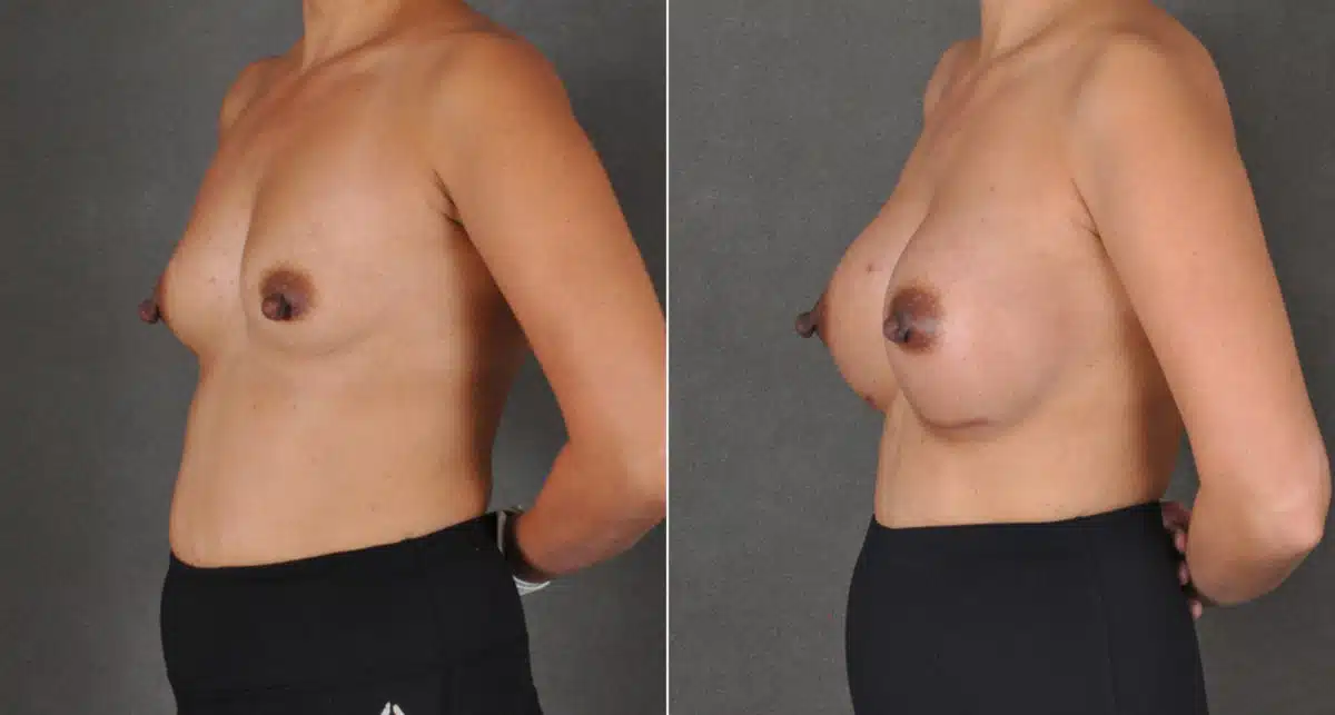 Breast Augmentation Before and After Photos in Omaha, NE, Case 16136