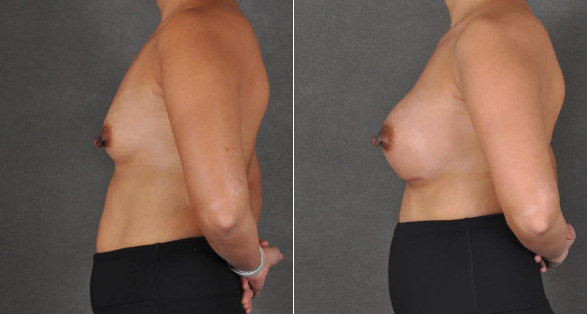 Breast Augmentation Before and After Photos in Omaha, NE, Case 16136