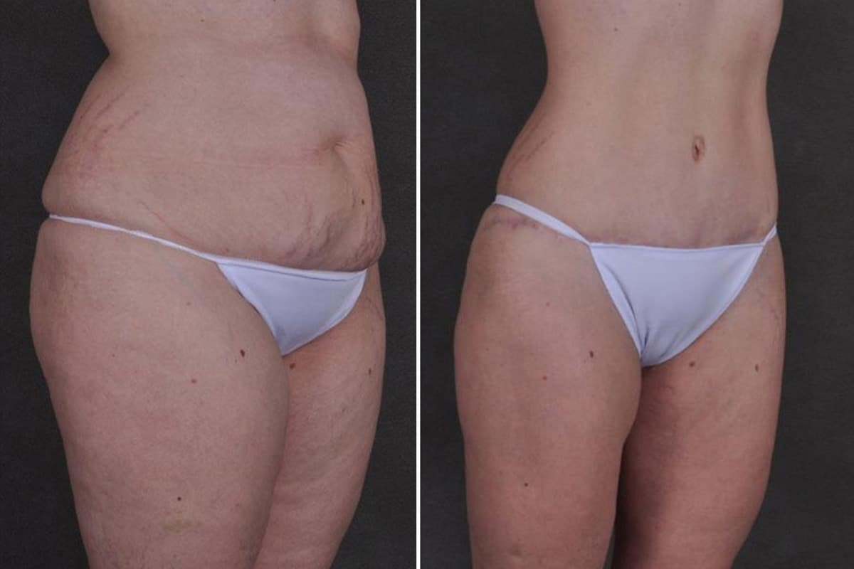 Our patient is THREE MONTHS post Plus Size Tummy Tuck ®! She is lookin