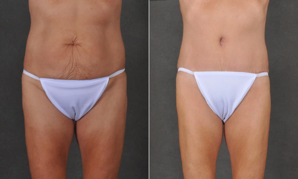 Case 16846, Tummy Tuck Before and After Photos Tummy Tuck Before and After Photos in Omaha, NE, Case 16846