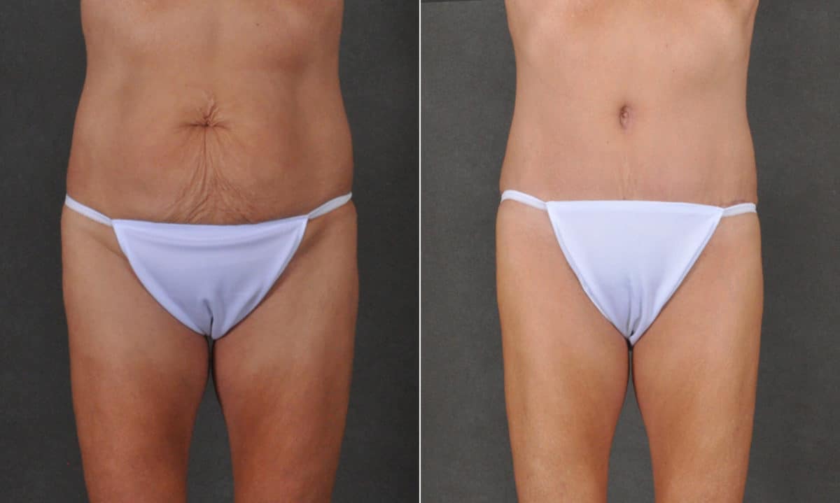 Tummy Tuck Before and After Photos in Omaha, NE, Case 16846