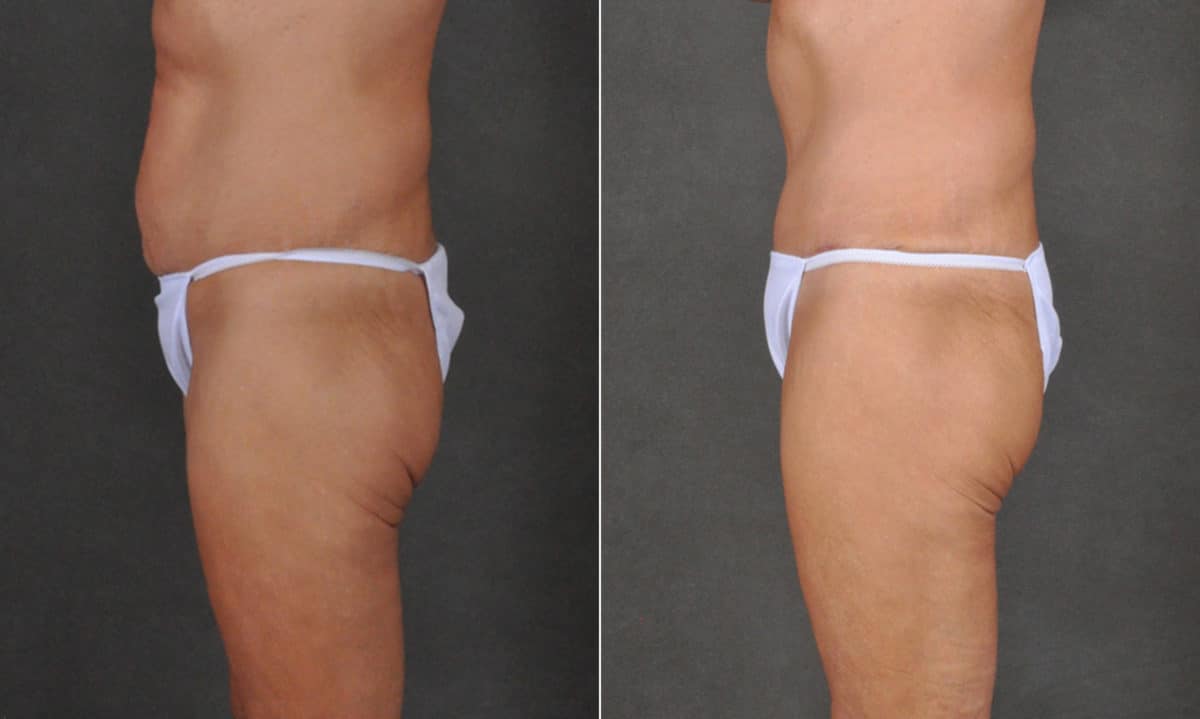 Tummy Tuck Before and After Photos in Omaha, NE, Case 16846