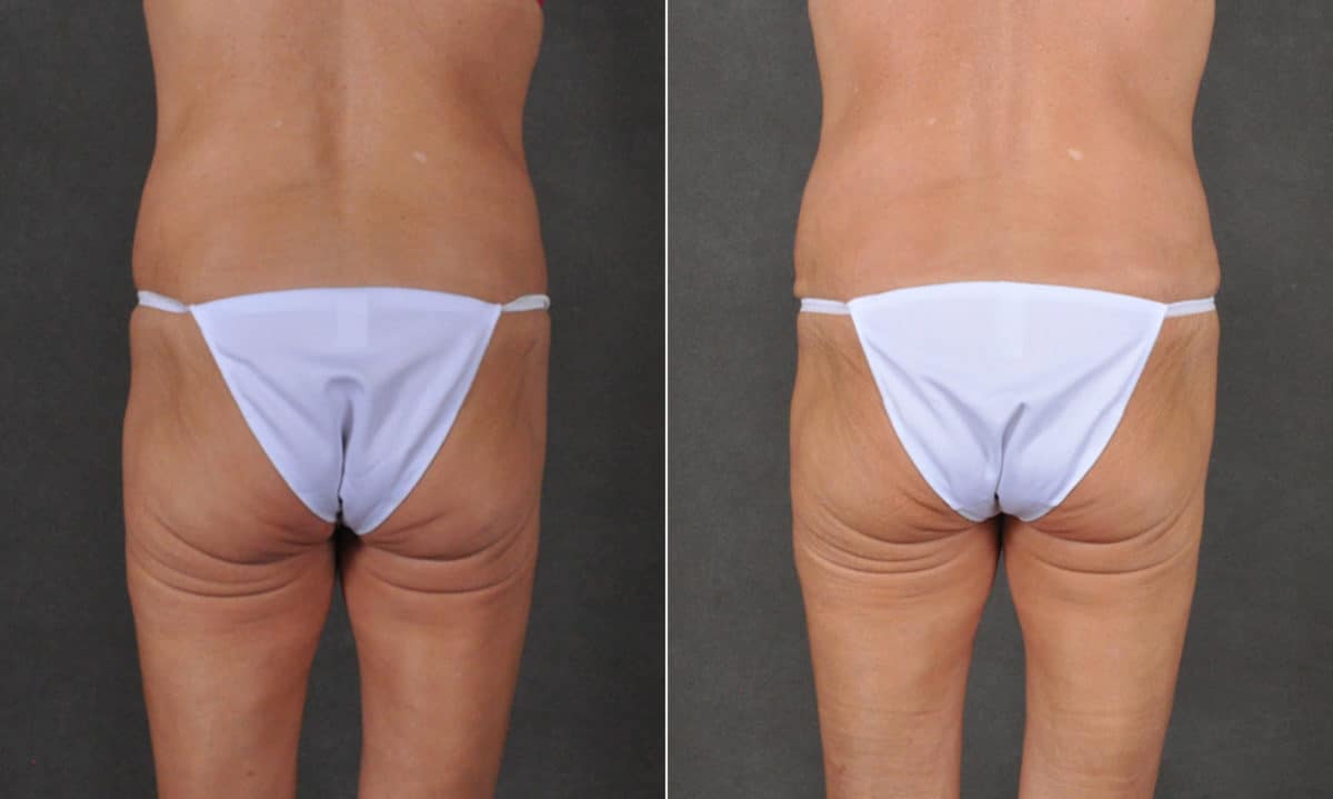 Case 16846, Tummy Tuck Before and After Photos Tummy Tuck Before and After Photos in Omaha, NE, Case 16846
