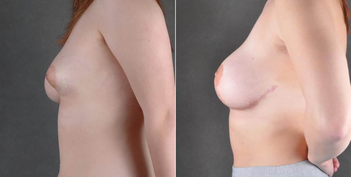 Case 16232, Breast Lift Before and After Photos Breast Lift Before and After Photos in Omaha, NE, Case 16232
