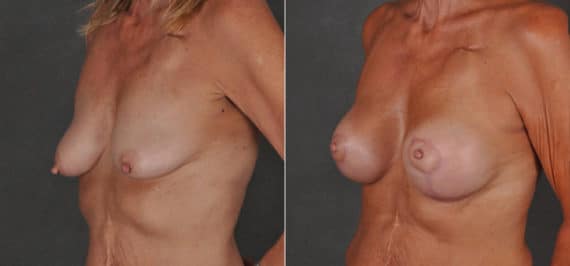 Breast Augmentation Before and After Photos in Omaha, NE, Case 16816