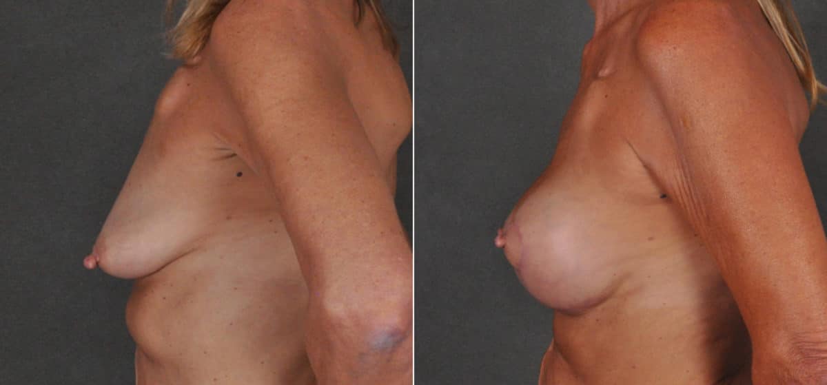 Breast Augmentation Before and After Photos in Omaha, NE, Case 16816