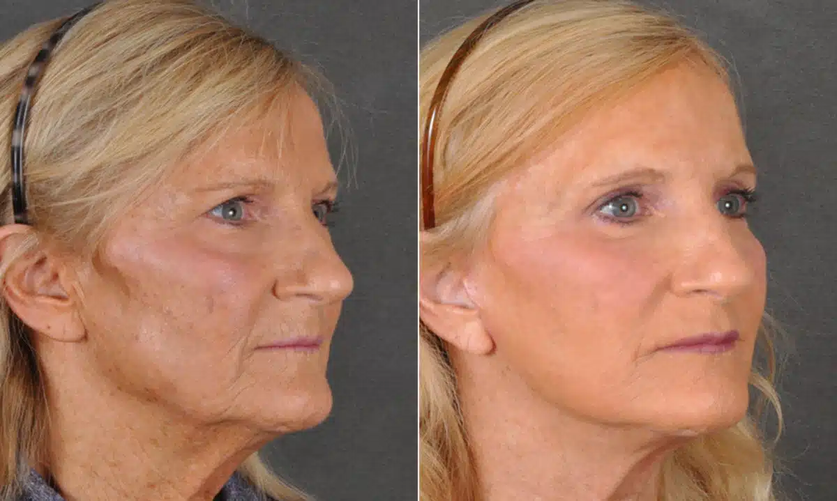 Blepharoplasty Before and After Photos in Omaha, NE, Case 16826