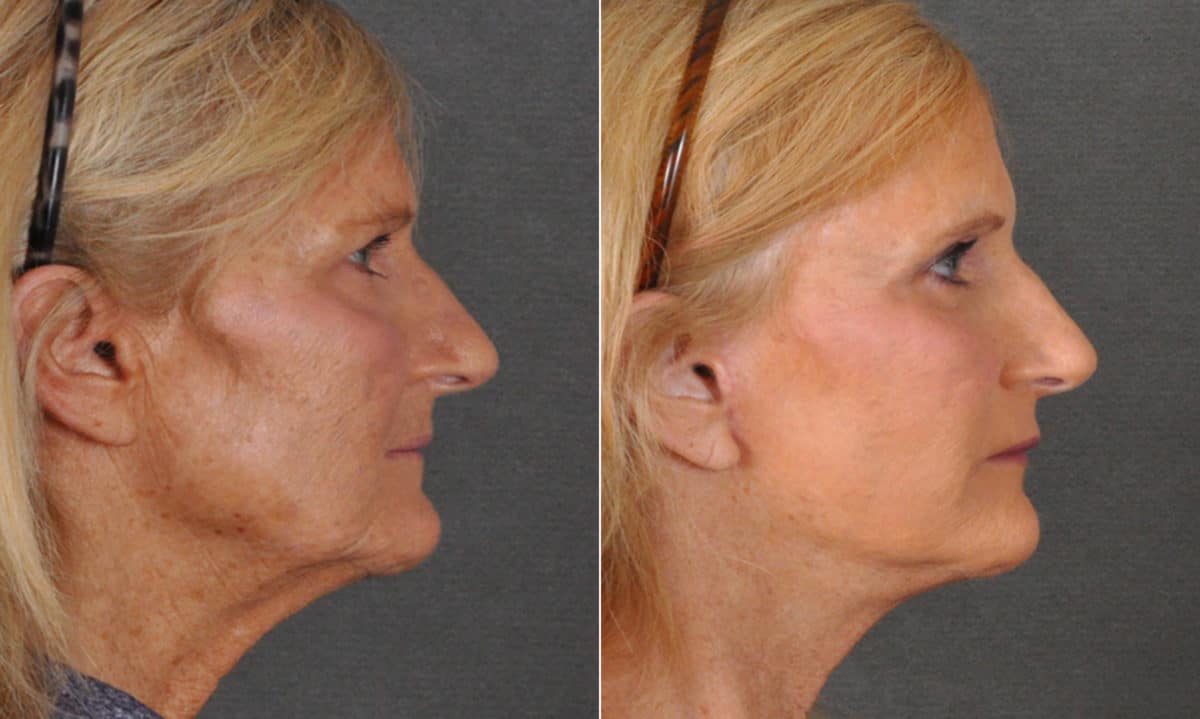 Blepharoplasty Before and After Photos in Omaha, NE, Case 16826